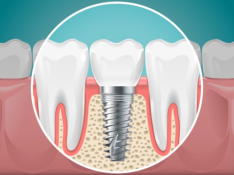 Imediátní implantace 